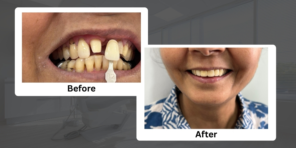 Crown & Bridge Treatment in Chembur