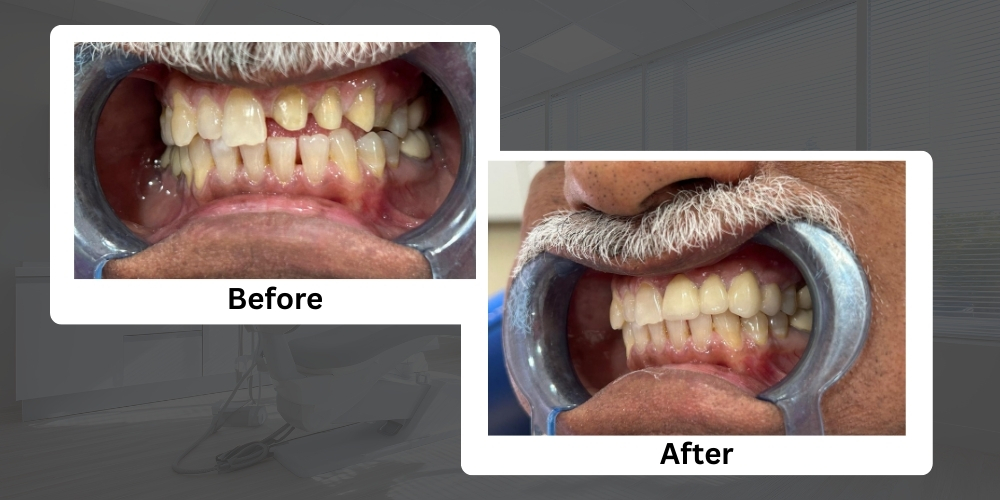 Crown & Bridge Treatment in Chembur