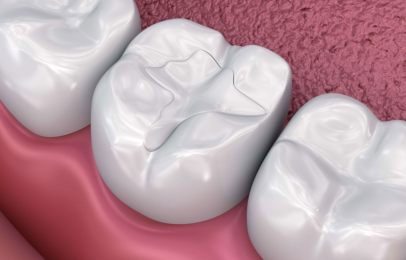 Cavity Filling In Chembur