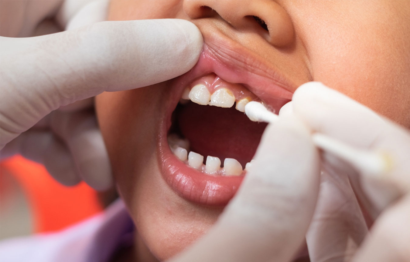 Fluoride and Dental Sealants in Chembur