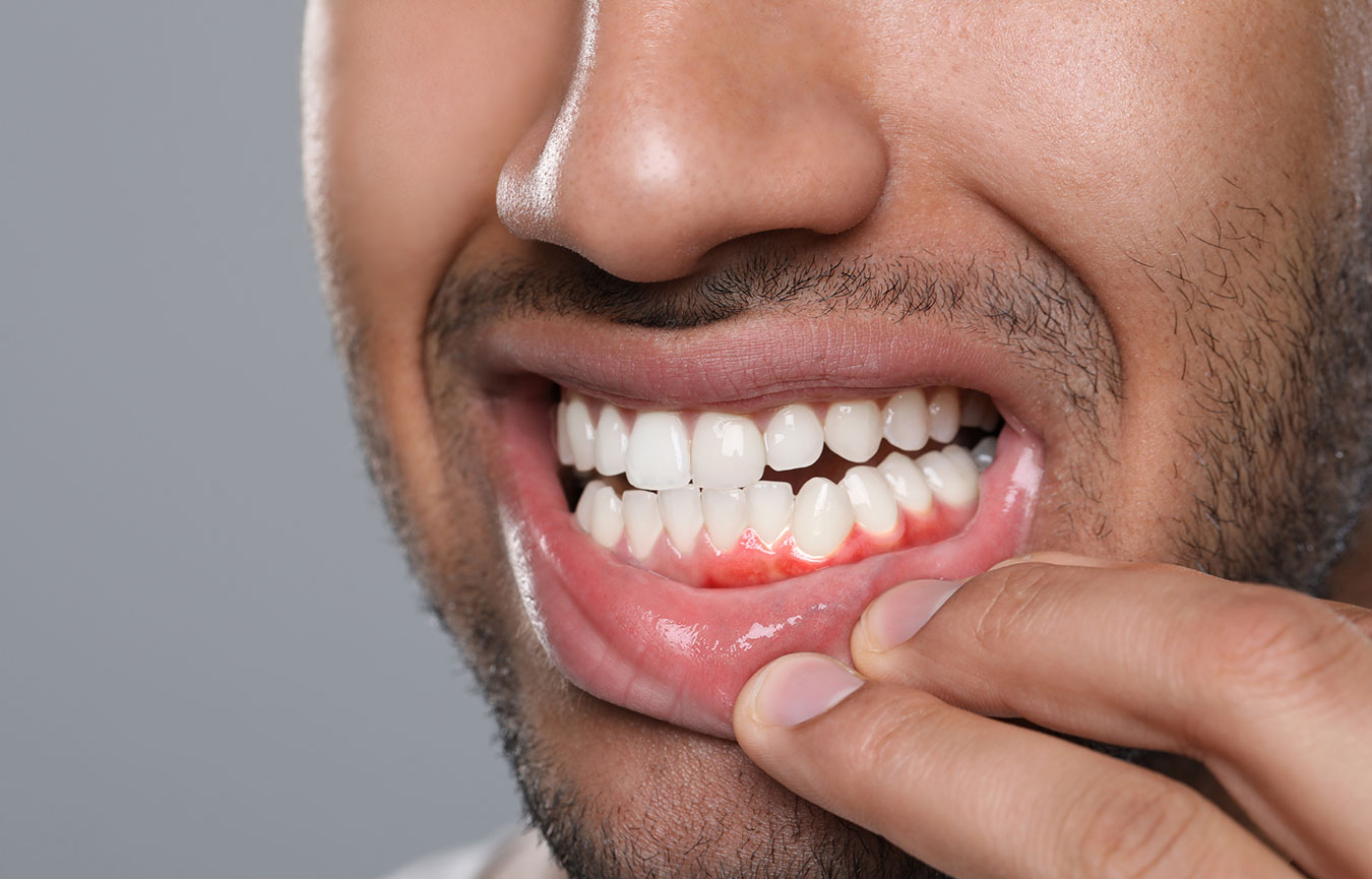 Gum Treatment in Chembur