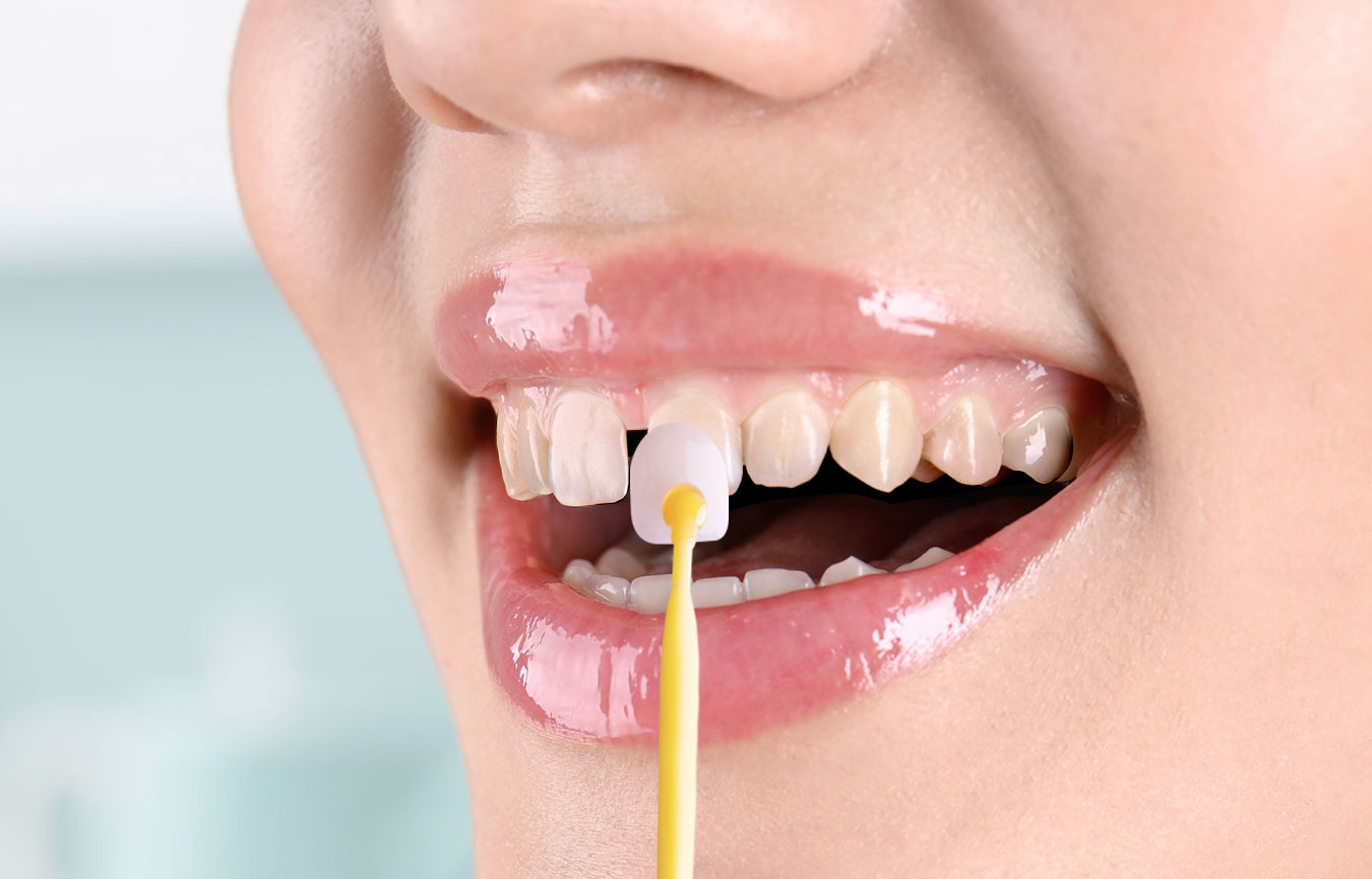 Veneer Treatment in Chembur