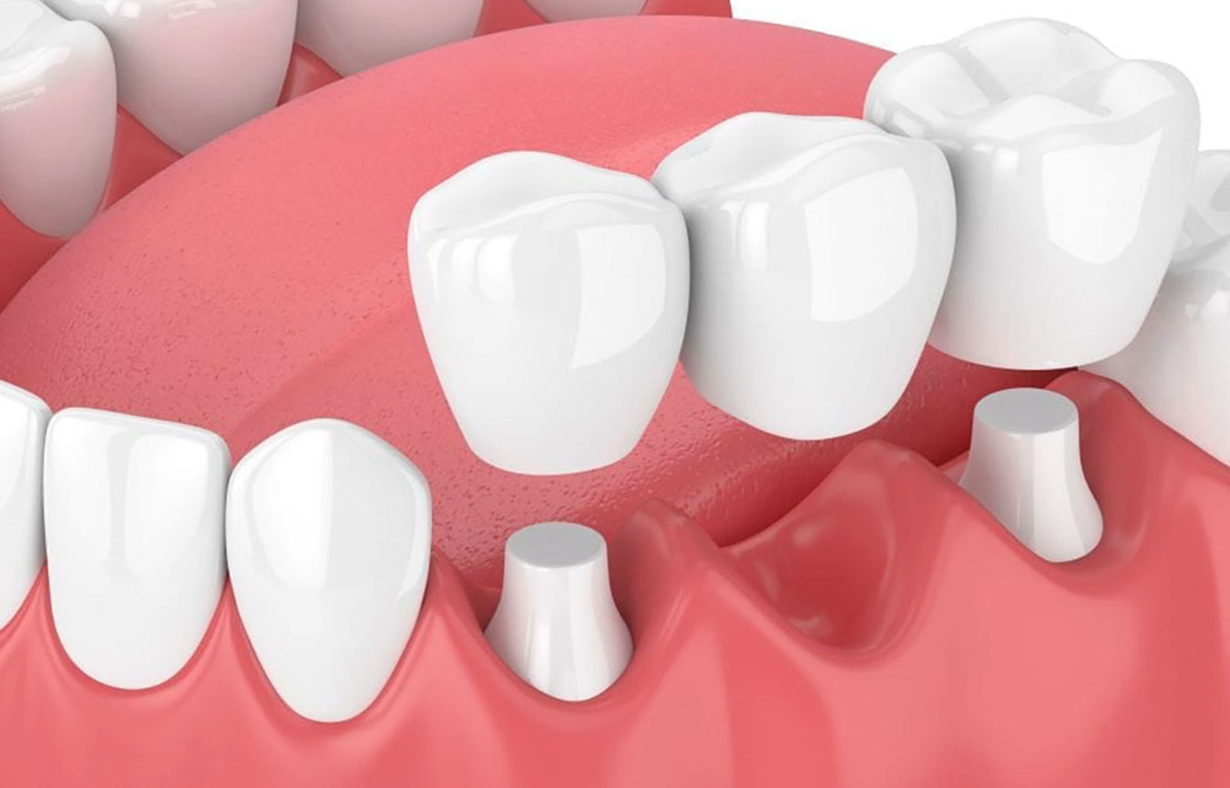 Crown & Bridge Treatment in Chembur
